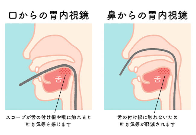 経鼻（鼻から）・経口（口から）ともに対応